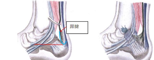 为什么有的人脚脖子粗，有的人脚脖子细？