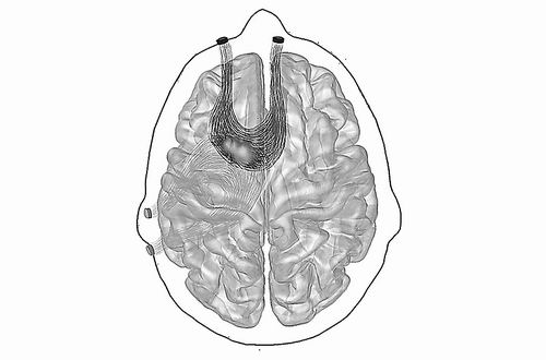 无需手术即可刺激大脑深部，新技术有望治疗癫痫和其他脑病