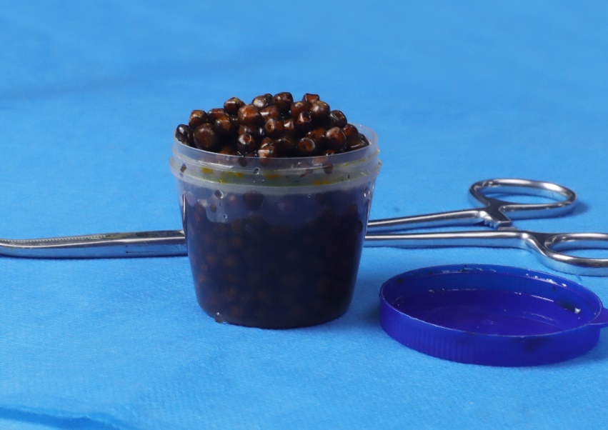 胆囊里面有“宝石”？千颗“石榴石”结石从贵阳七旬老人体内取出