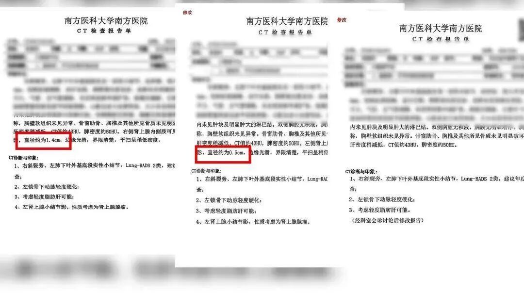 女子体检被出具3份不同CT报告，经历“过山车”式惊吓！医院通报致歉