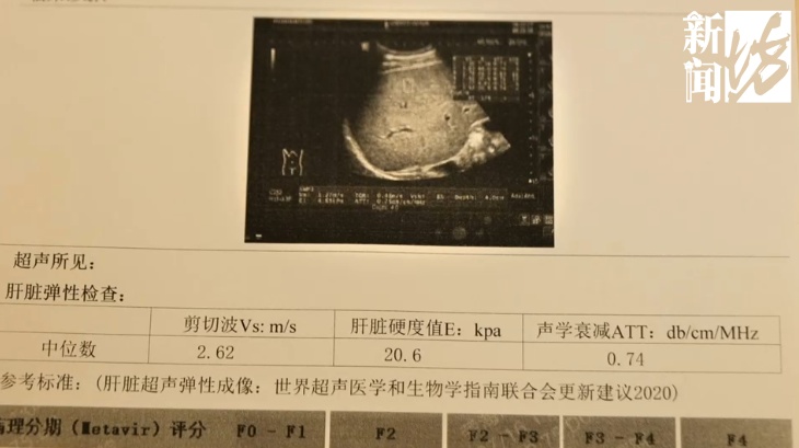 上海30岁小伙每天1斤白酒，连喝8年！结果吐血了！一查麻烦大了...