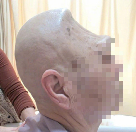 76岁老妇四分之一头骨没了，3D打印助其再造头骨