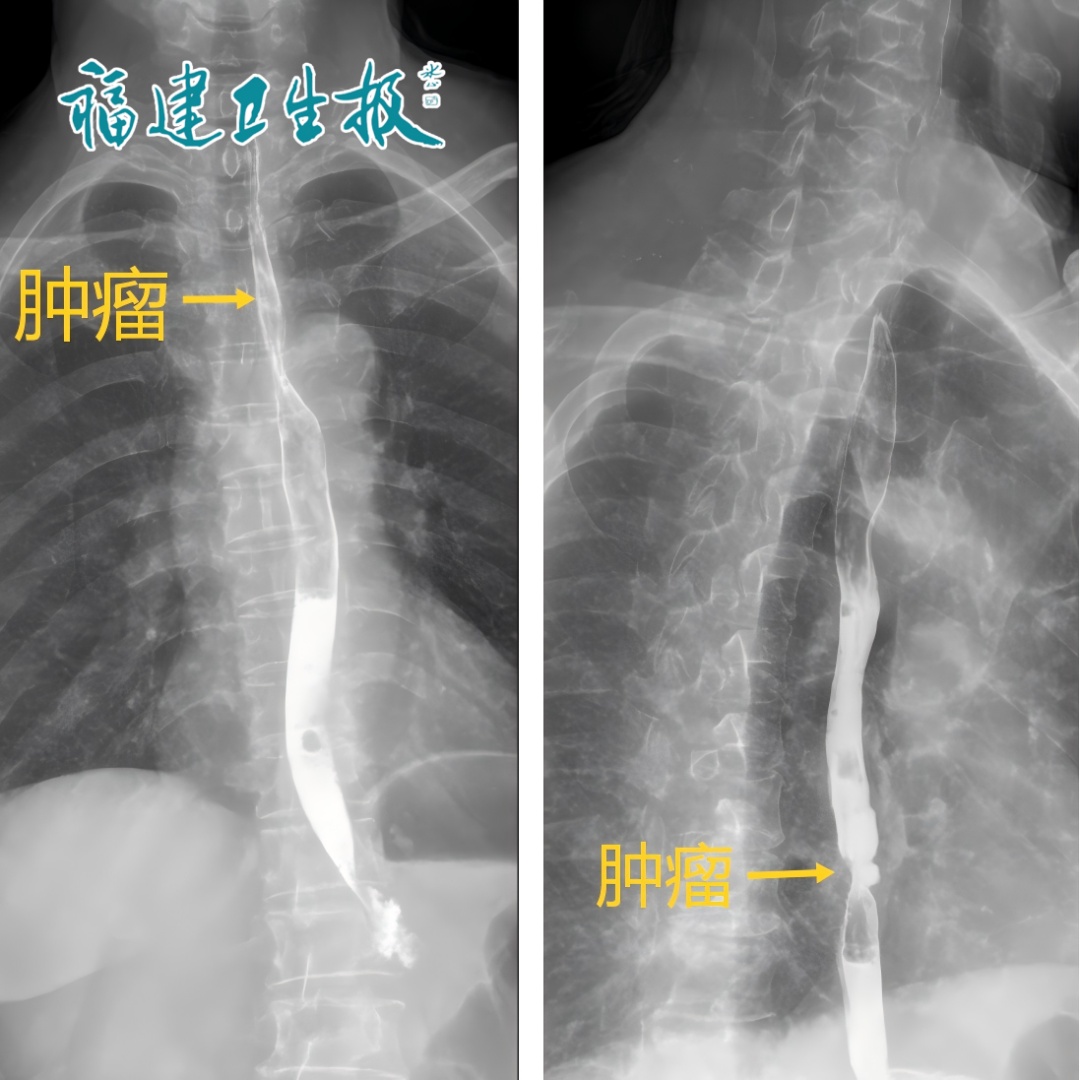 福建一对夫妻双双确诊癌症，问题竟出在饭桌上！很多人都有这种习惯！