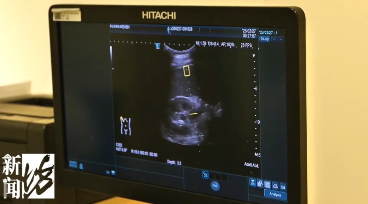 上海30岁小伙每天1斤白酒，连喝8年！结果吐血了！一查麻烦大了...