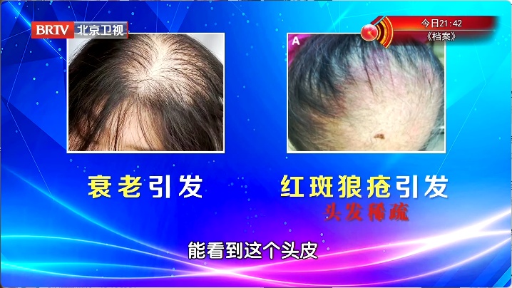 让头发狂掉的真凶是它！赶紧对镜自查，教你“抢救”发量