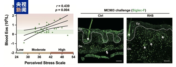 压力大会加重皮炎 中国科学家首次发现科学证据