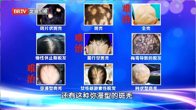 让头发狂掉的真凶是它！赶紧对镜自查，教你“抢救”发量