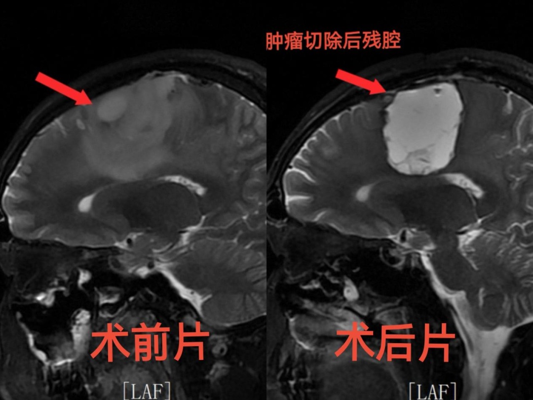 27岁小伙长脑肿瘤，开颅过程中被医生叫醒报地名、捏小黄鸭，确保手术操作范围无误