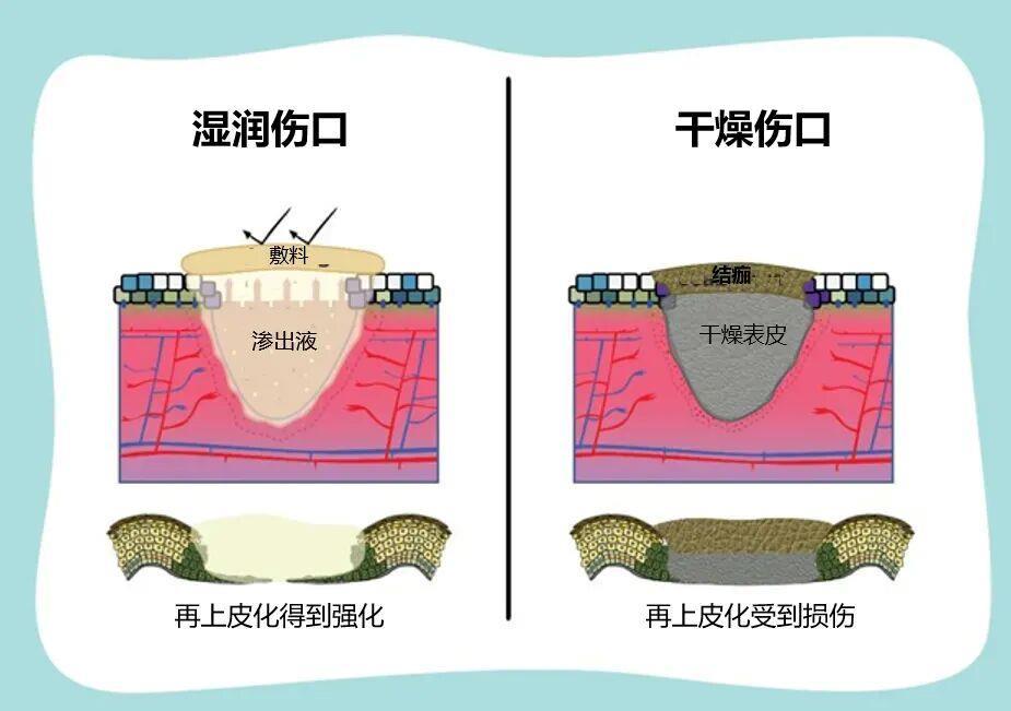 伤口“晾干”好还是“保湿”好?一文给你说清楚 伤口“晾干”好还是“保湿”好?一文给你说清楚