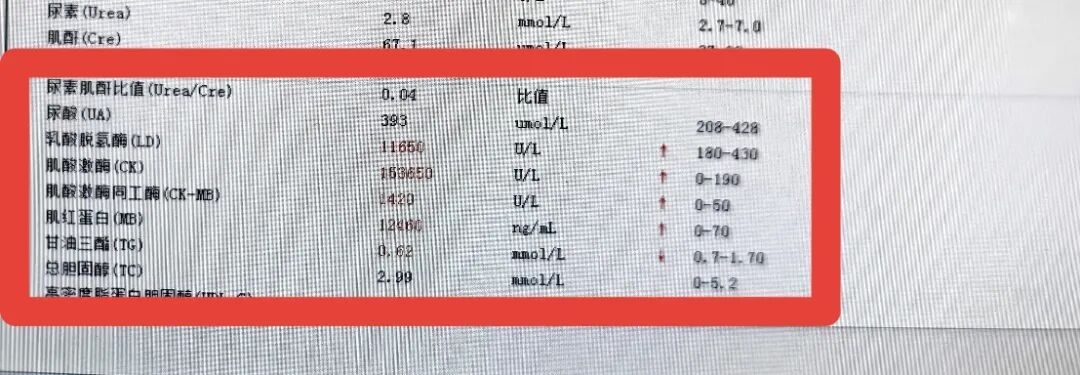 14岁男生冲刺中考体育,狂练2小时游泳,竟致“酱油尿”紧急住院 14岁男生冲刺中考体育,狂练2小时游泳,竟致“酱油尿”紧急住院