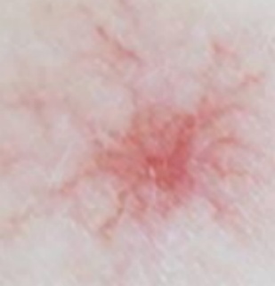 身上发痒一查竟是肝癌?别忽视肝脏这4个“求救信号” 身上发痒一查竟是肝癌?别忽视肝脏这4个“求救信号”