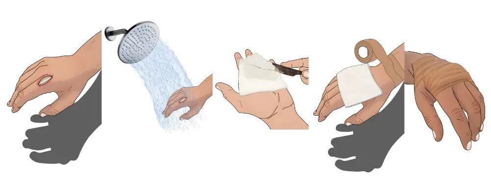 伤口“晾干”好还是“保湿”好?一文给你说清楚 伤口“晾干”好还是“保湿”好?一文给你说清楚