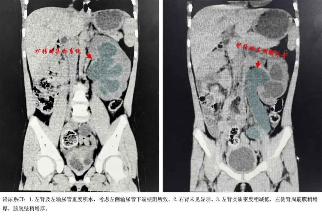 医生惊了!福建4岁女孩天生只有一个肾,还堵住了 医生惊了!福建4岁女孩天生只有一个肾,还堵住了