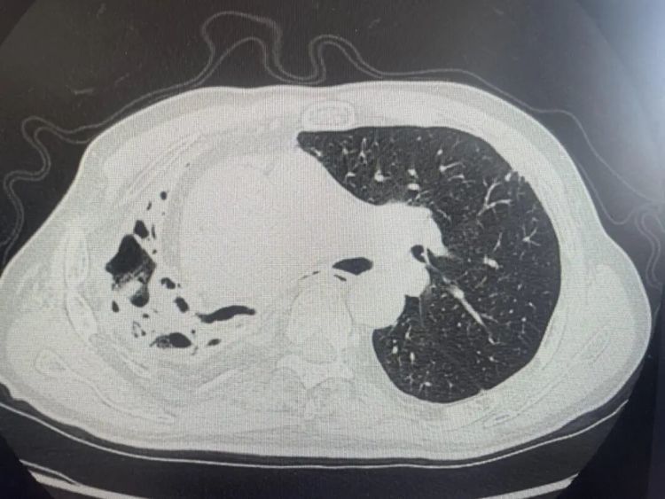 浙江大爷上山挖笋，突然反复咯血，右肺严重毁损！医生：致死风险较高