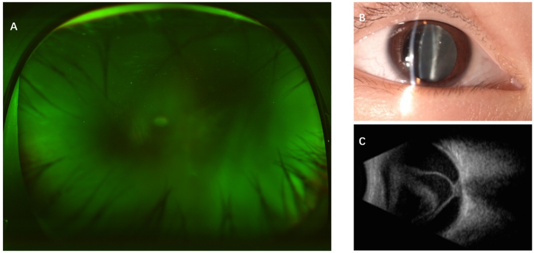 “蛔虫”钻眼，4岁男童视网膜脱离！杭城医生：近期接诊3例，这种隐患很多人有