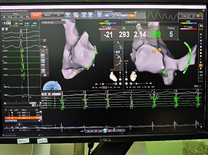 孕30周准妈妈心动过速反复发作,医护“零辐射”为她解除心疾 孕30周准妈妈心动过速反复发作,医护“零辐射”为她解除心疾
