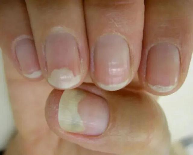 求助！指甲为什么总从这个地方断开啊？是缺钙吗？