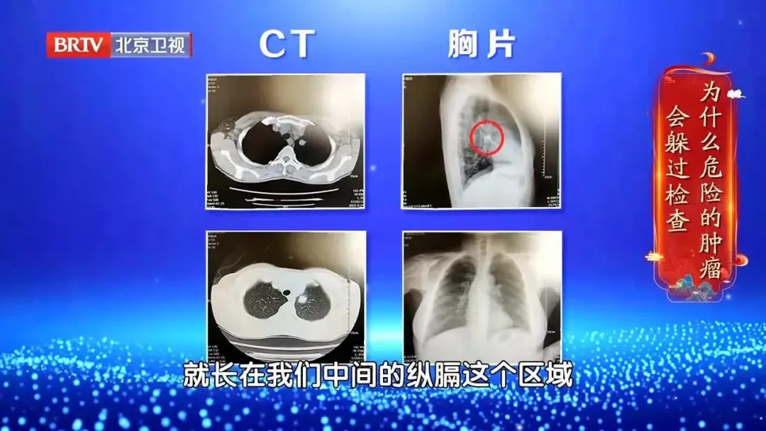 辐射量是胸片的650倍！这个肿瘤筛查体检项目，卫健委并不推荐普通人盲目做……