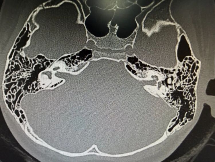 12岁女孩左耳“失聪”12年，妈妈哽咽：我只想让她有个耳朵洞……