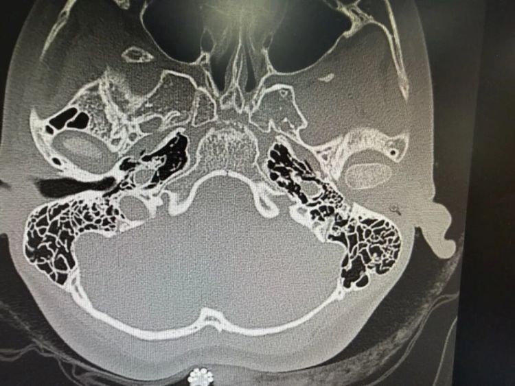 12岁女孩左耳“失聪”12年，妈妈哽咽：我只想让她有个耳朵洞……