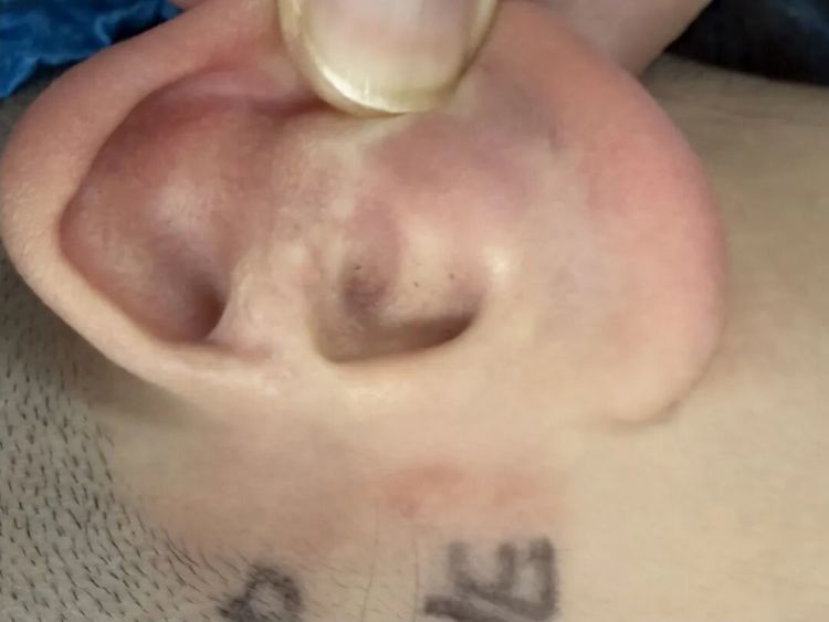 12岁女孩左耳“失聪”12年，妈妈哽咽：我只想让她有个耳朵洞……