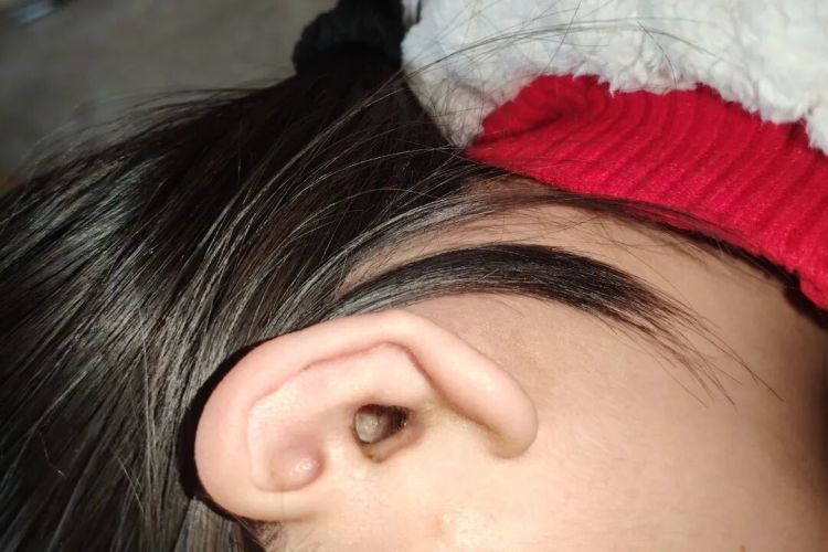 12岁女孩左耳“失聪”12年，妈妈哽咽：我只想让她有个耳朵洞……