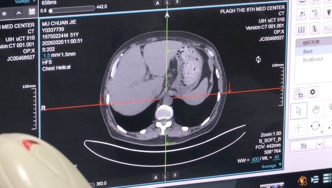 肺结核，人人都可能感染！医生提醒：这样预防——