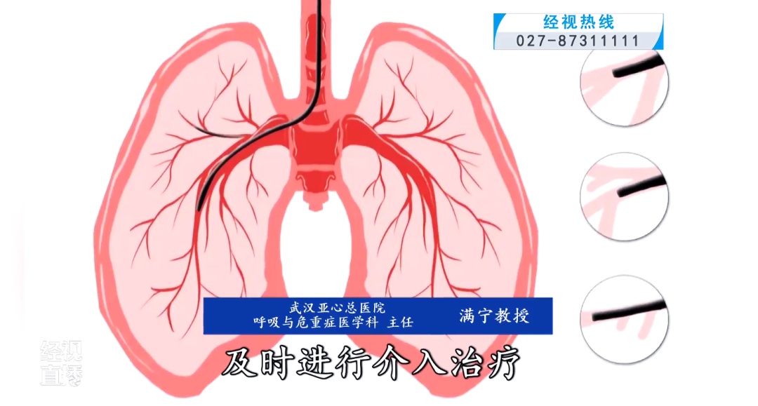 63岁男子十年间反复咯血未重视，病情恶化紧急送医！医生：长年大量吸烟是核心病因