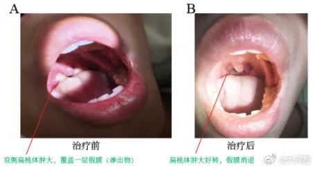 湖南23岁男子反复高热、进食困难，被确诊“亲吻病”，医生：很容易以为是“普通感冒”