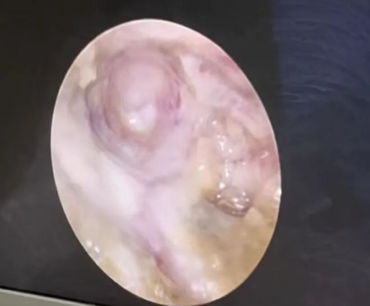 12岁女孩左耳“失聪”12年，妈妈哽咽：我只想让她有个耳朵洞……