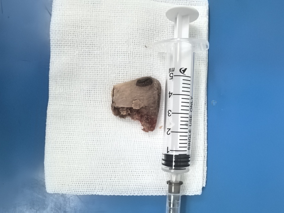 11岁男孩吃汤泡饭被4cm猪骨卡食管，医生提醒：异物卡喉别喝醋、催吐