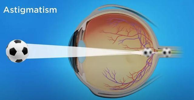 总是模糊重影，看灯会散开，你的眼睛可能出现这种问题了