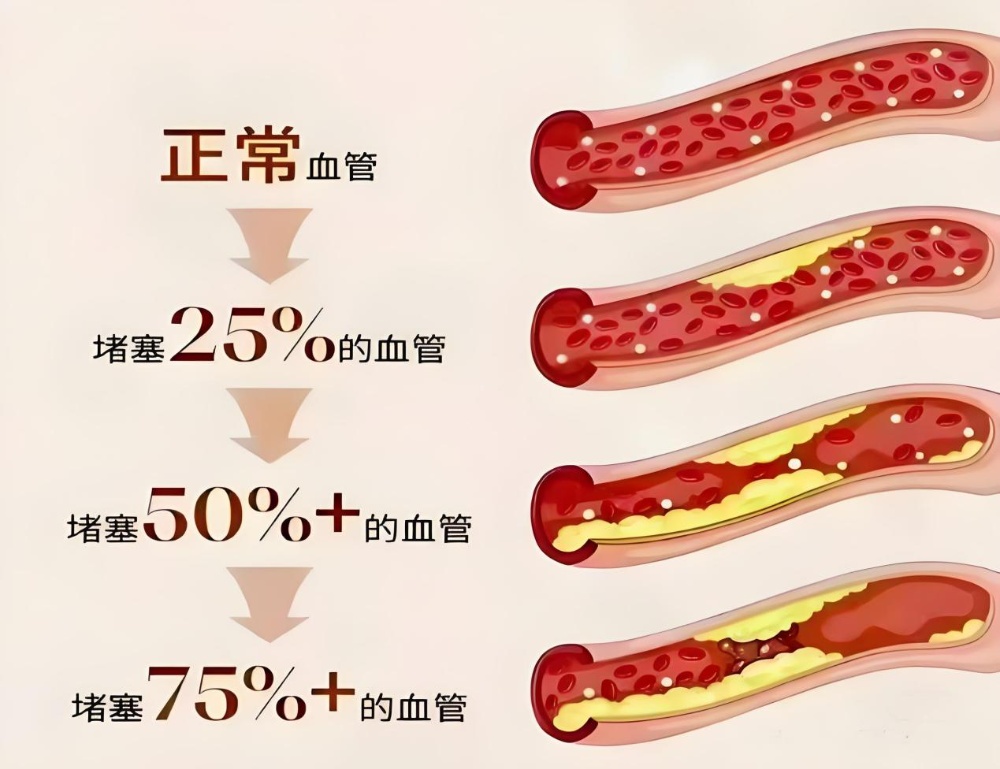 合肥周女士紧急送医！近期警惕心梗易发！医生提醒：这些不典型信号要当心