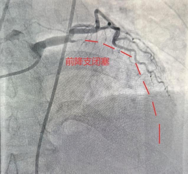 合肥周女士紧急送医！近期警惕心梗易发！医生提醒：这些不典型信号要当心