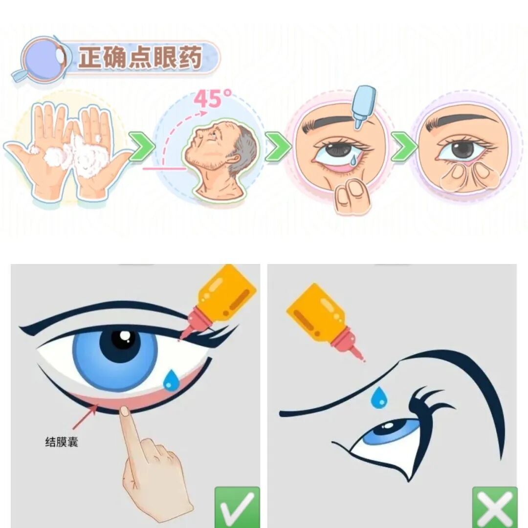 别再错着点眼药水！这3个误区，很多人每天都在犯
