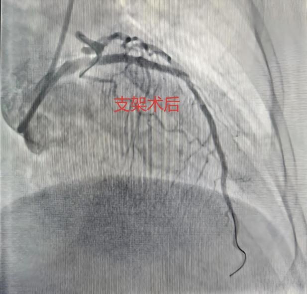 合肥周女士紧急送医！近期警惕心梗易发！医生提醒：这些不典型信号要当心