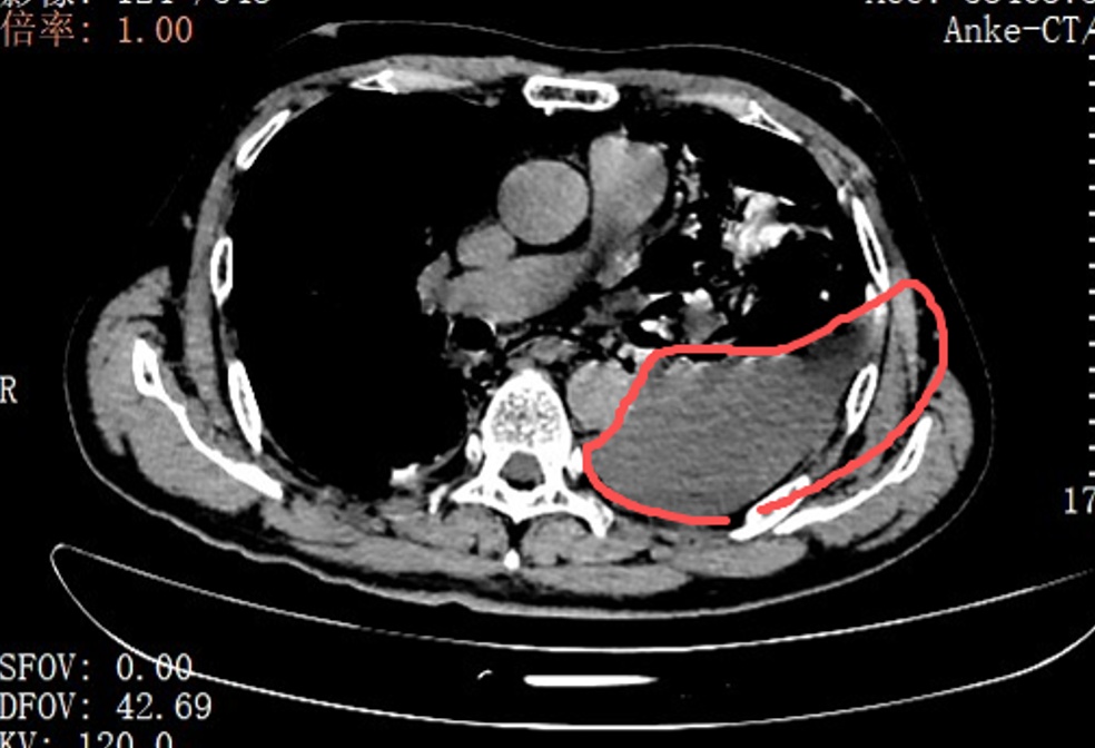 “胸口像被炸开!”男子症状极像心梗,一查胸腔内竟全是剩菜渣! “胸口像被炸开!”男子症状极像心梗,一查胸腔内竟全是剩菜渣!