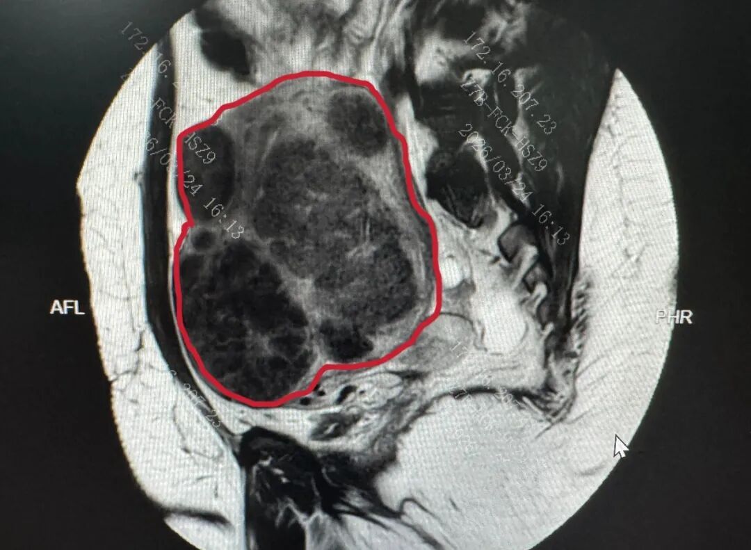 女子被痛经折磨23年,差点切除子宫!深圳医生“剔”出656颗瘤子 女子被痛经折磨23年,差点切除子宫!深圳医生“剔”出656颗瘤子