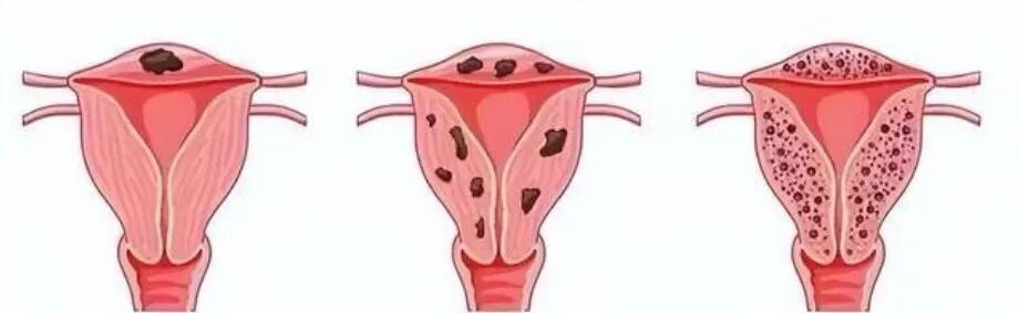 女子被痛经折磨23年,差点切除子宫!深圳医生“剔”出656颗瘤子 女子被痛经折磨23年,差点切除子宫!深圳医生“剔”出656颗瘤子