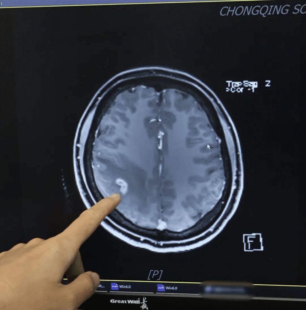 女子多年肢体麻木求医无果，重庆专家从其脑中取出一条白色、粉条状的3厘米活虫