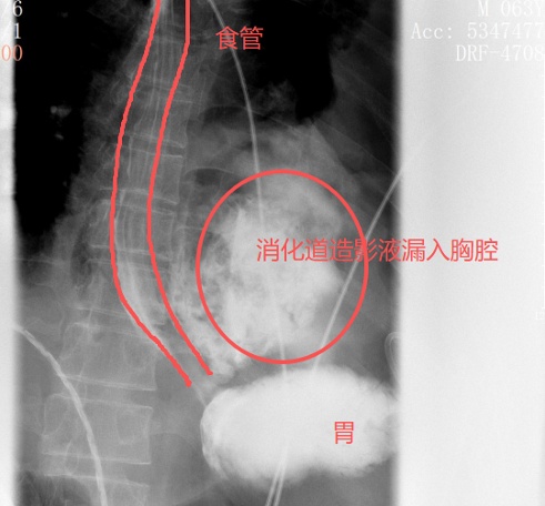 “胸口像被炸开!”男子症状极像心梗,一查胸腔内竟全是剩菜渣! “胸口像被炸开!”男子症状极像心梗,一查胸腔内竟全是剩菜渣!