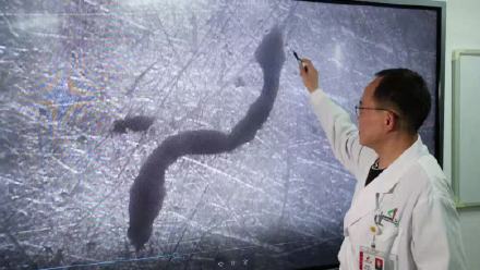 3cm寄生虫待女子脑内5年 3cm寄生虫待女子脑内5年