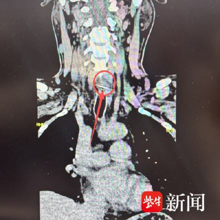 男子吃鱼头被金属针卡喉 男子吃鱼头被金属针卡喉
