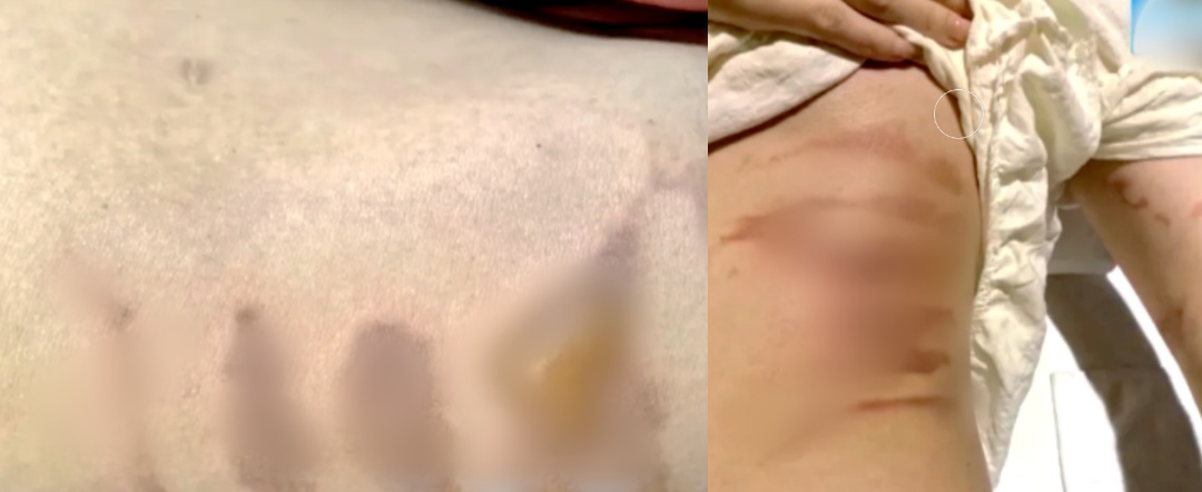 本想养生却进了医院！女子拔火罐被烧伤，酒精起火如何灭？