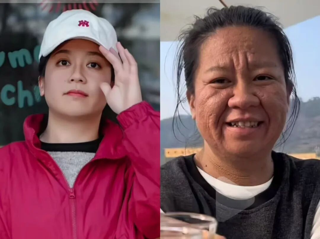 32岁宝妈怀孕后容貌大变！医生：并非单一皮肤问题，产后可逐步恢复