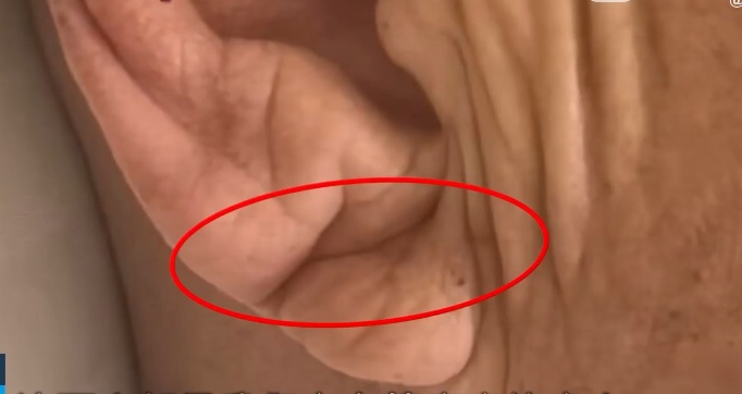 七旬老人陪老伴住院被医生一眼发现猝死先兆，一检查，血管狭窄程度已高达99%