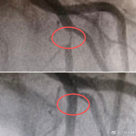 27岁女子胸闷一查血管堵了95% 医生：每天奶茶、外卖，疏于运动
