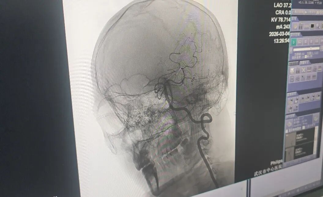 33岁,肩颈按摩后突发脑梗!医生警告 33岁,肩颈按摩后突发脑梗!医生警告
