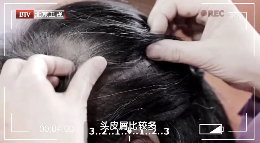 头发2种表现,当心是身体炎症“爆表”了!多吃3种“消炎食物”能改善 头发2种表现,当心是身体炎症“爆表”了!多吃3种“消炎食物”能改善