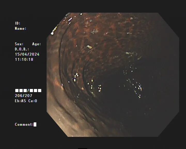 女子便秘10年，肠道变黑，被迫切掉30厘米！竟因这类网红产品换着吃，医生提醒→